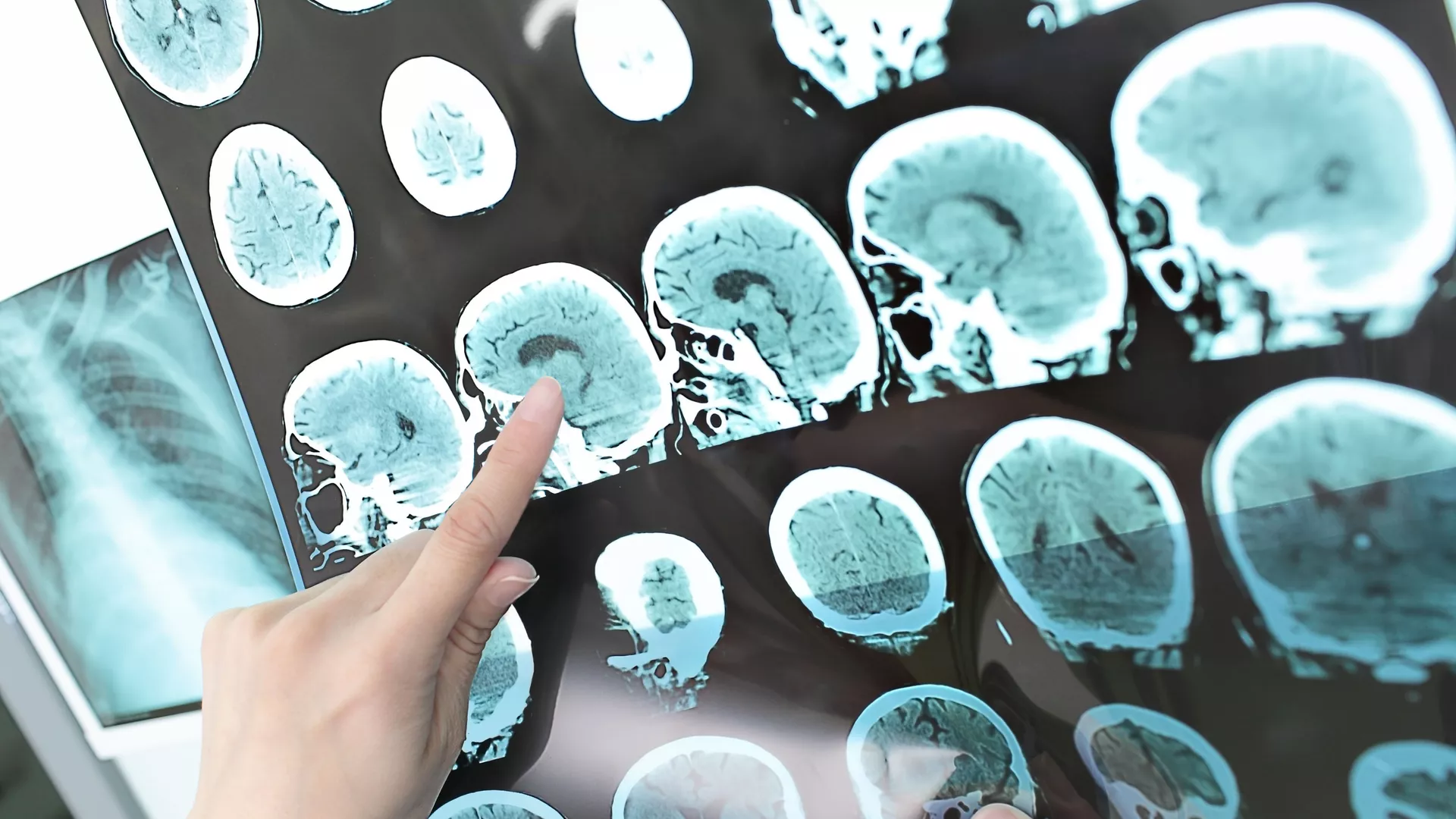脳のMRI