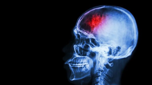 脳卒中の発症リスクを高める要因　研究者が特定 - Sputnik 日本