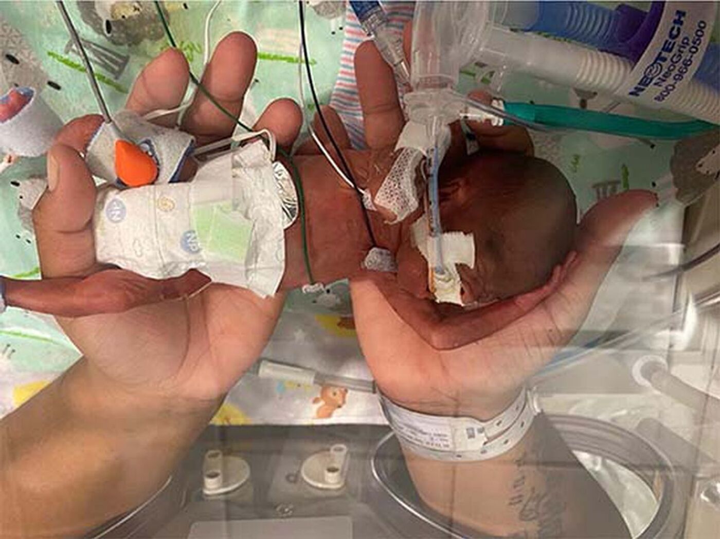 420グラムで生まれた米国の男の子、ギネス世界記録に認定 世界一の早産