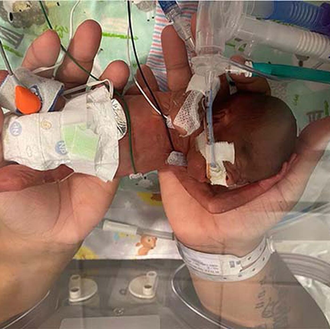 アメリカ生まれの男の子 World's smallest baby