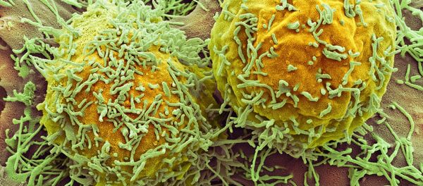 人工知能、ほくろと皮膚がんの差異を見分ける技を習得 人工知能、ほくろと皮膚がんの差異を見分ける技を習得 - Sputnik 日本