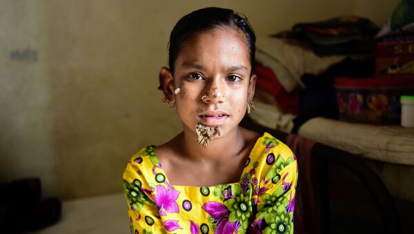 バングラデシュ少女　女性として初めて「樹木人症候群」に？　【動画】 - Sputnik 日本