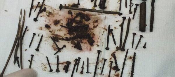 74歳のロシア人女性の胃の中から150個の金属物が見つかる 74歳のロシア人女性の胃の中から150個の金属物が見つかる - Sputnik 日本