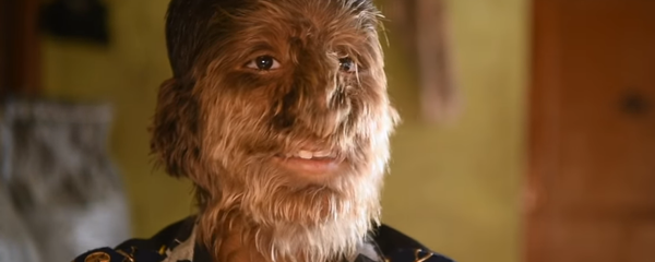 インド少年、珍しい病気で「狼男」のようになる - Sputnik 日本