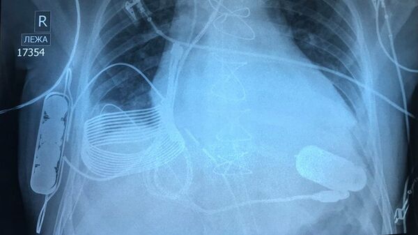 Рентгеновский снимок грудной клетки мужчины, которому вживили бионическое сердце с возможностью беспроводной зарядки - Sputnik 日本