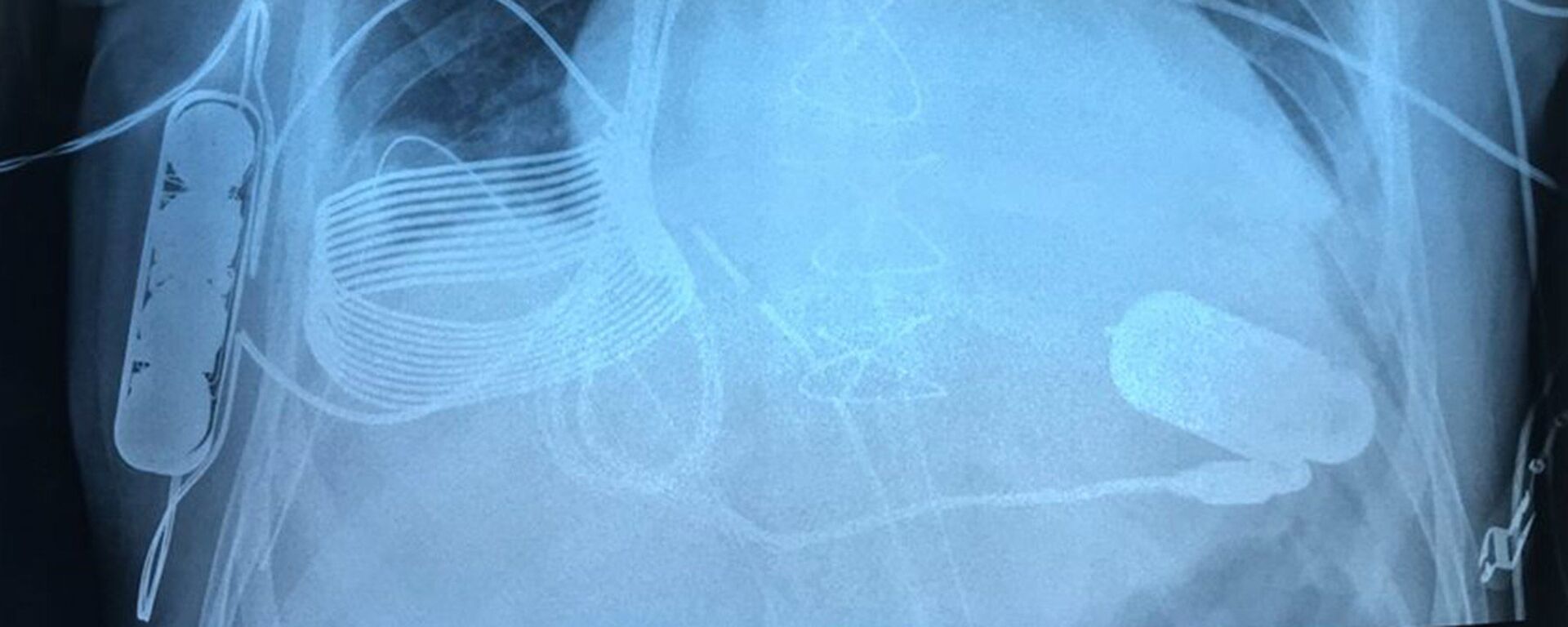 末期の心不全患者に「無線充電式」人工心臓が移植される - Sputnik 日本, 1920, 22.07.2021