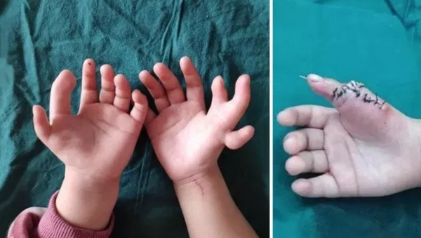 １４本の指で生まれた少女の手術を成功　中国 - Sputnik 日本