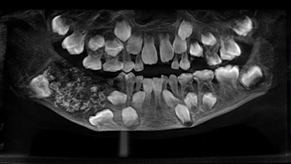 7歳の少年から526本の歯を除去 - Sputnik 日本