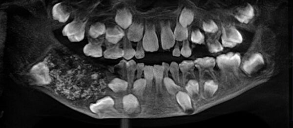 7歳の少年から526本の歯を除去 7歳の少年から526本の歯を除去 - Sputnik 日本