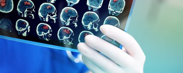 脳癌 脳癌 - Sputnik 日本